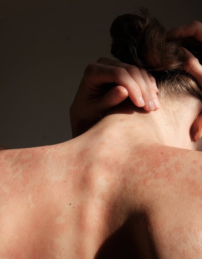 Moderni fototerapijos įranga „InSense Clinic“ padeda veiksmingiau gydyti žvynelinę