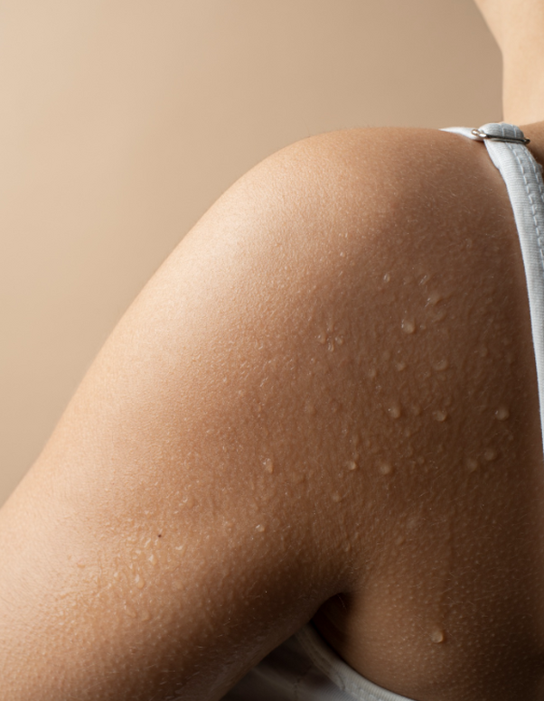 Gausus prakaitavimas: kaip botulino toksino injekcijos gali padėti?