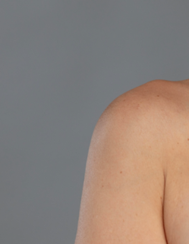 Psoriasis: Causes, Symptoms and Treatment